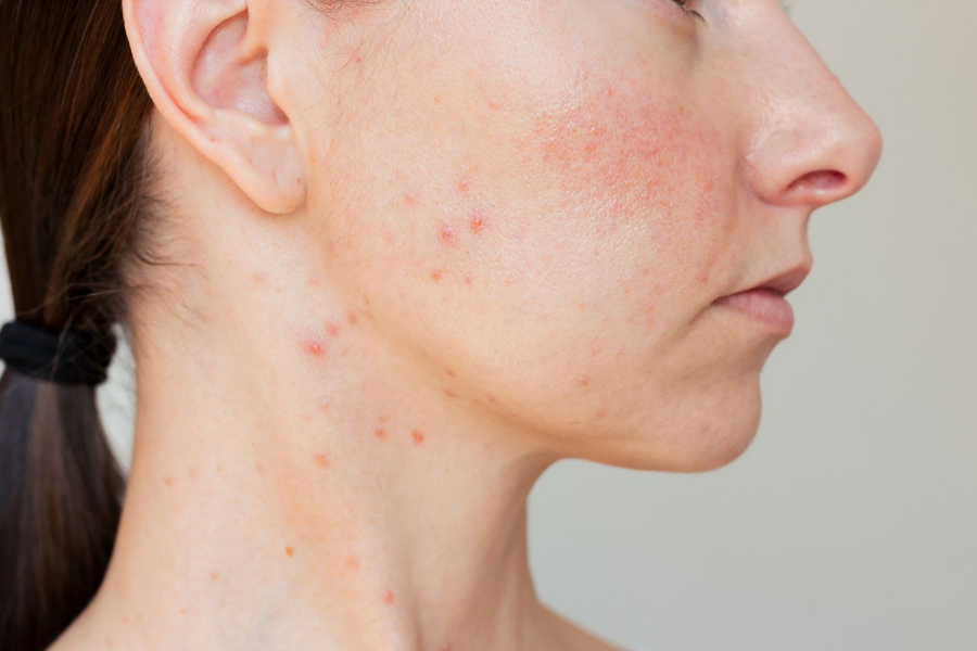 The Full-Body Reset: How a Medicated Soap for Acne Clears Skin Below the Neck 2 Medicated Soap